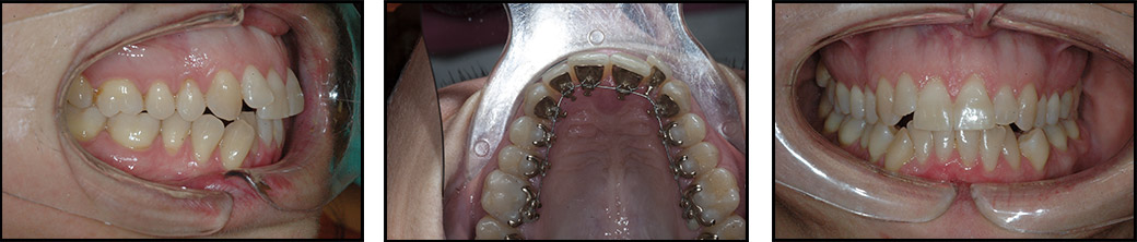 ortodonzia-linguale