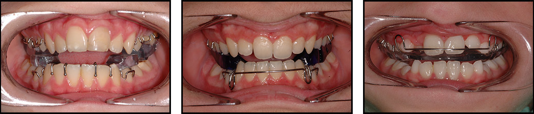 ortodonzia-intercettiva-apparecchi-mobili