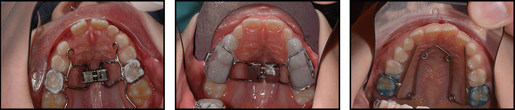 ortodonzia-intercettiva-espansore-palato