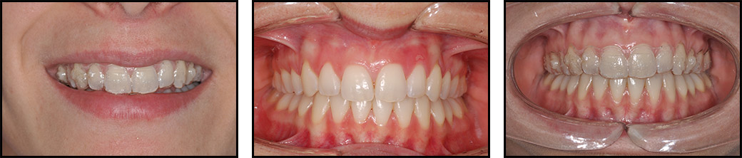 ortodonzia-invisibile