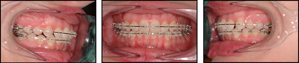 ortodonzia-vestibolare2